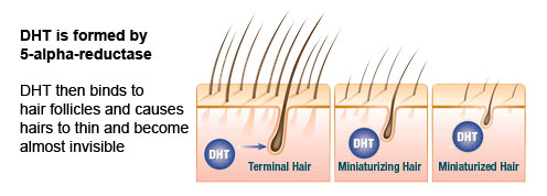 DHT-in-hair-loss